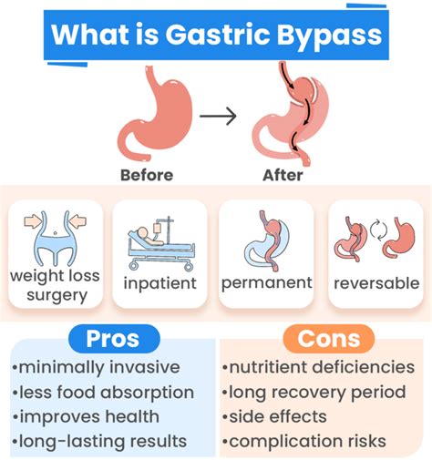 nude how to get gastric bypass surgery for free in ontario